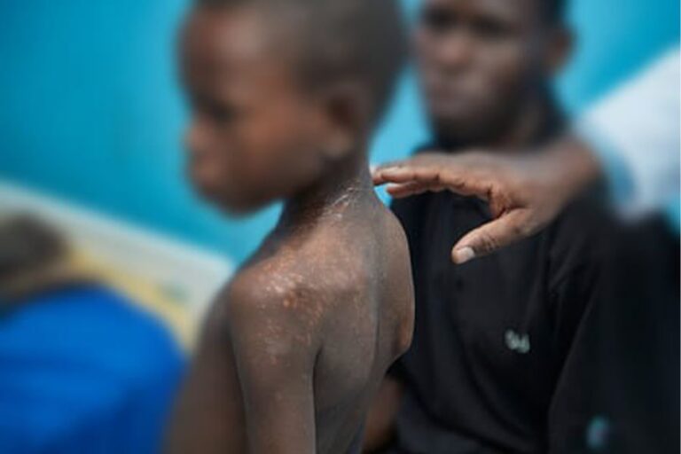 Breakthrough treatment for Neglected Skin Disease PKDL discovered in East Africa