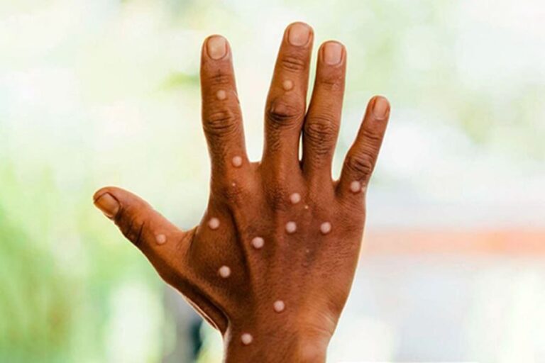 Mpox outbreak surges across East Africa 