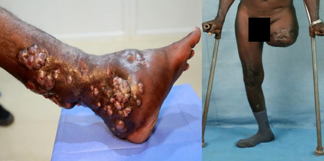 Ethiopia Intensifies Efforts to Combat Mycetoma, a Neglected Tropical Disease