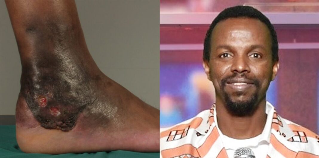 Mycetoma: A Neglected Tropical Disease Affecting Ethiopia’s Rural Communities